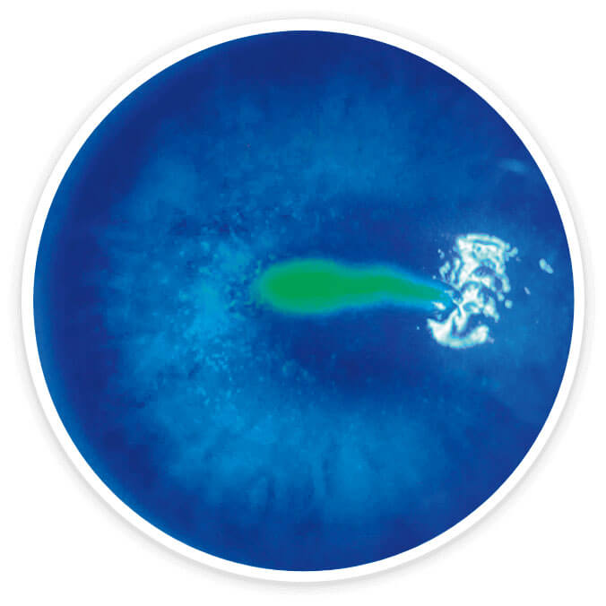Fluorescein-stained cornea at baseline from a patient with Stage 2 neurotrophic keratitis