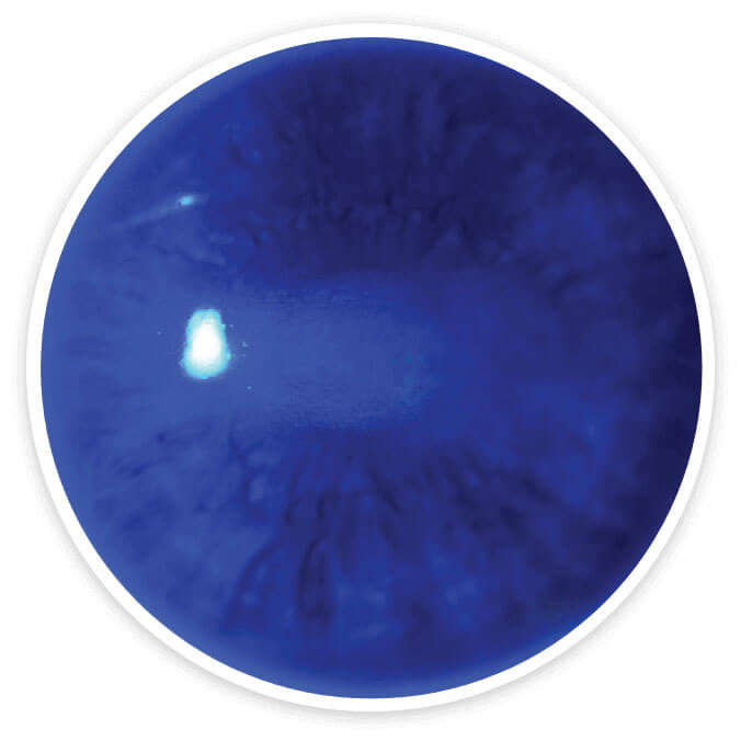 Fluorescein-stained cornea at week 8 from a patient with Stage 2 neurotrophic keratitis