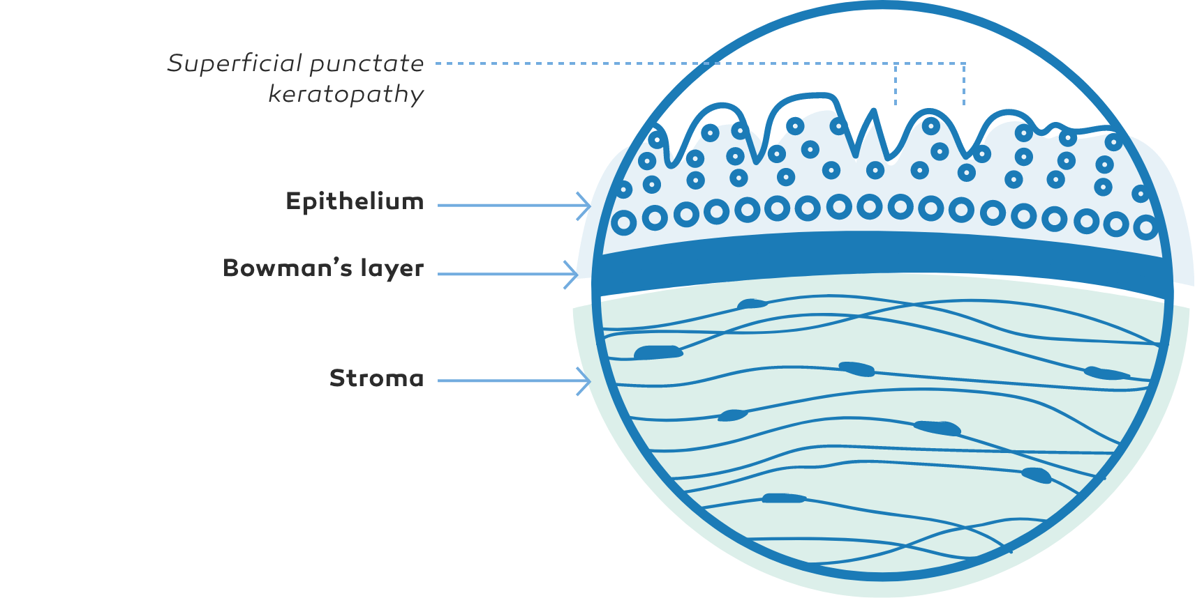 Diagram of Stage 1 NK showing SPK and damage to the epithelium above the Bowman's layer and stroma
