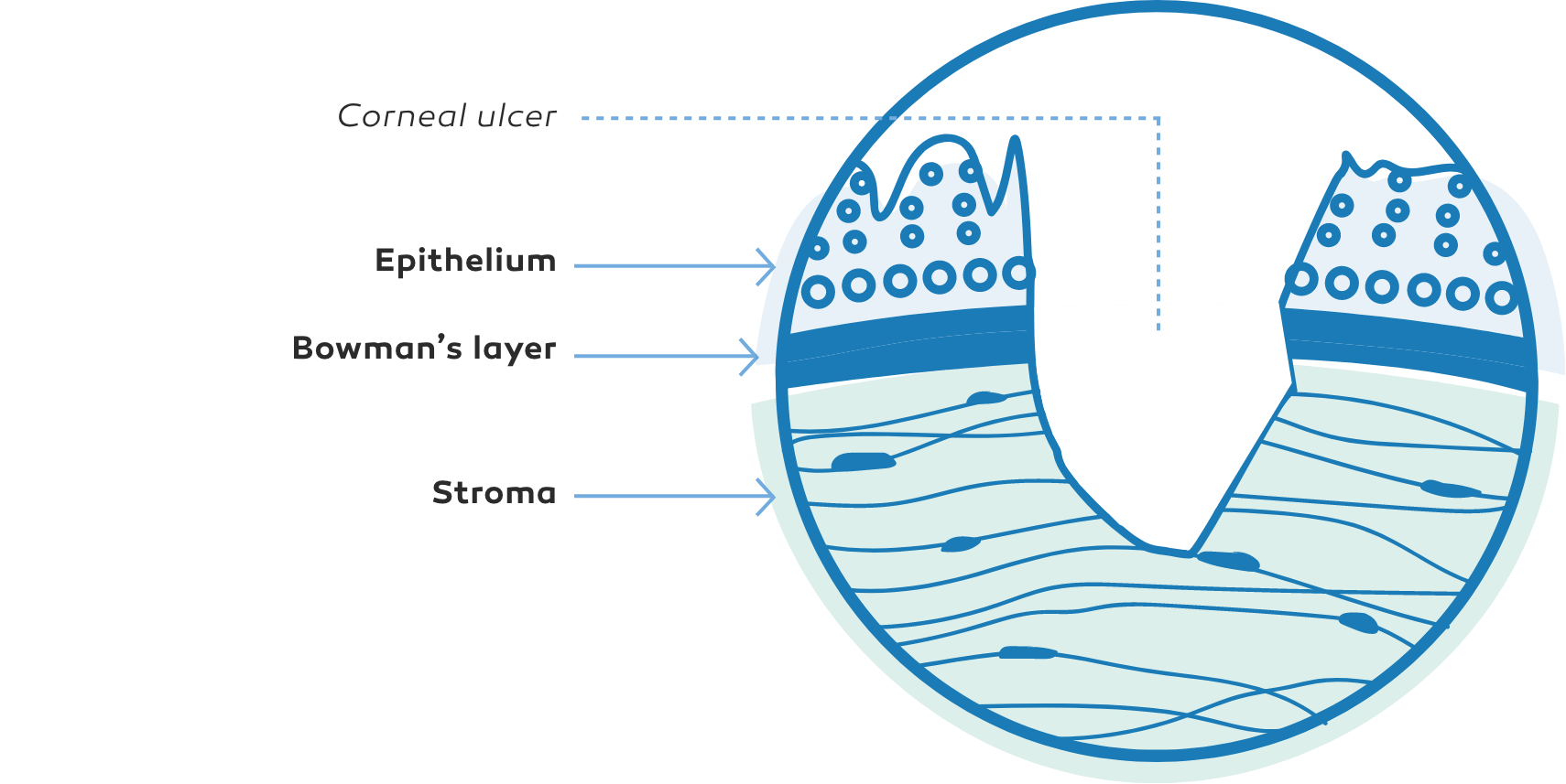Diagram of Stage 3 NK with corneal ulcer, epithelial loss, and stromal degradation