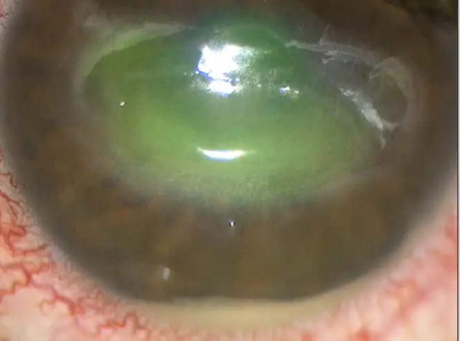 Stage 3